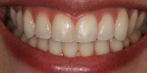 branqueamento-dentario