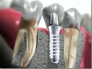 fotos-implantes-dentarios