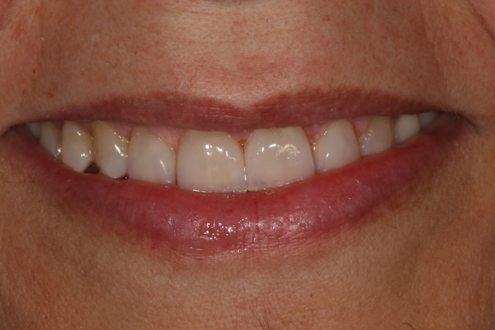 dentes-estetica|ortodontia:depois