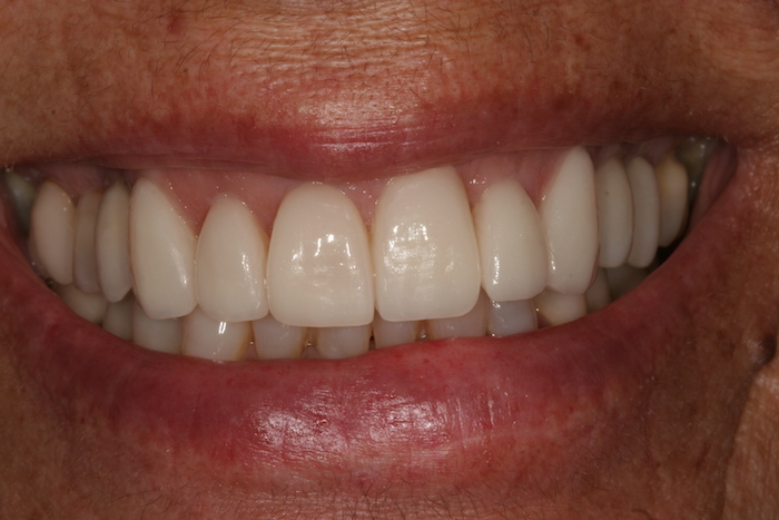 dentes-estetica|reabilitacao-oral:depois