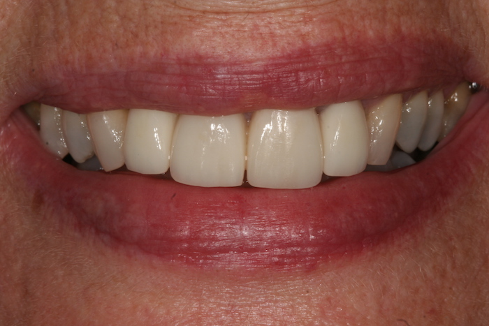 branqueamento-dentario|dentes-estetica|reabilitacao-oral:depois