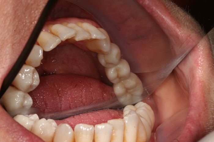 implantes|reabilitacao-oral:depois