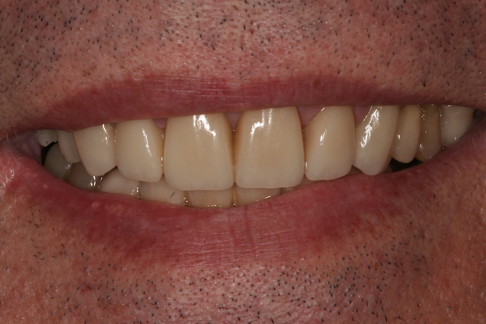 dentes-estetica|implantes|reabilitacao-oral:depois