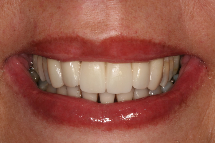 dentes-estetica|reabilitacao-oral:depois