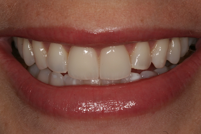 branqueamento-dentario|dentes-estetica:depois