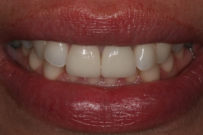 dentes-estetica:depois
