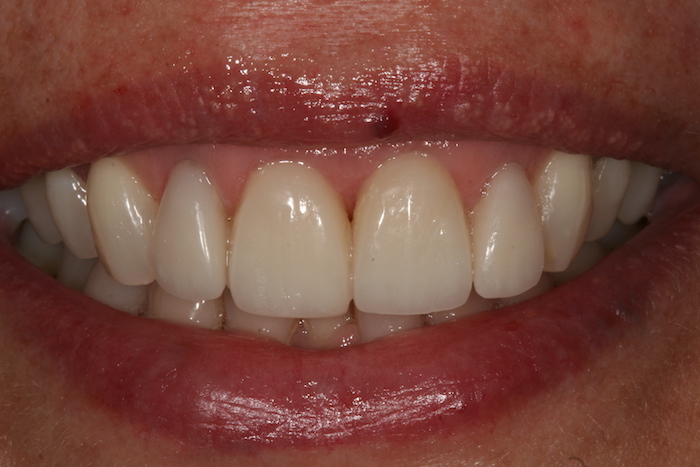 branqueamento-dentario|dentes-estetica:depois