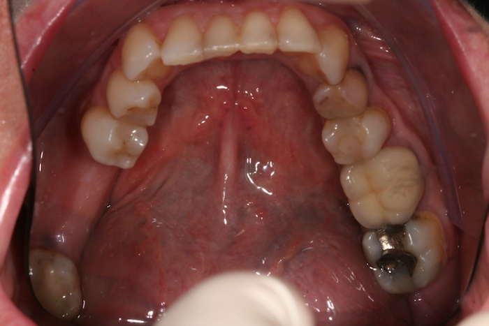 implantes|reabilitacao-oral:antes