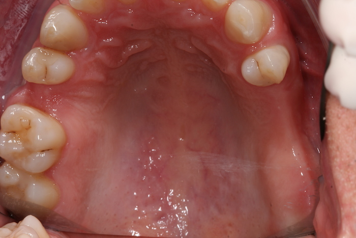 implantes|reabilitacao-oral:antes
