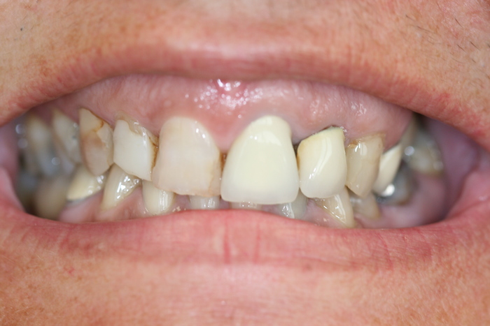 dentes-estetica|reabilitacao-oral:antes