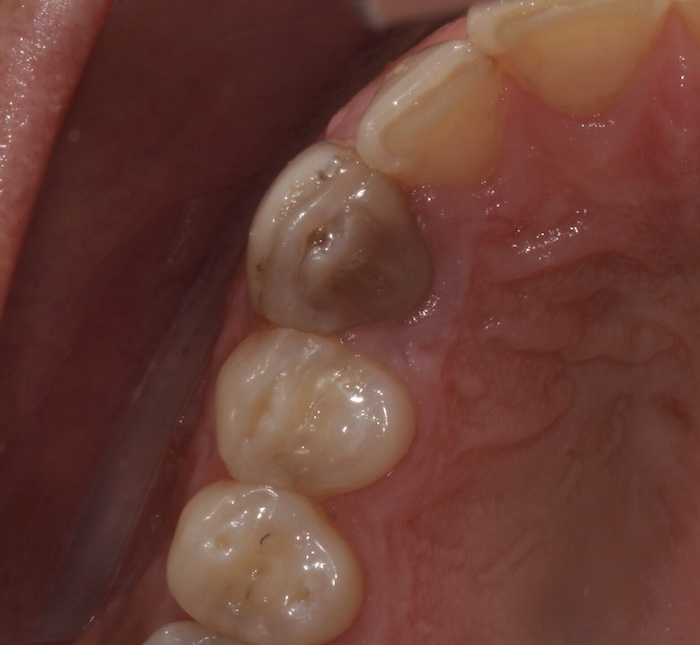 branqueamento-dentario:antes