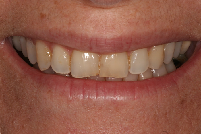 branqueamento-dentario|dentes-estetica:antes