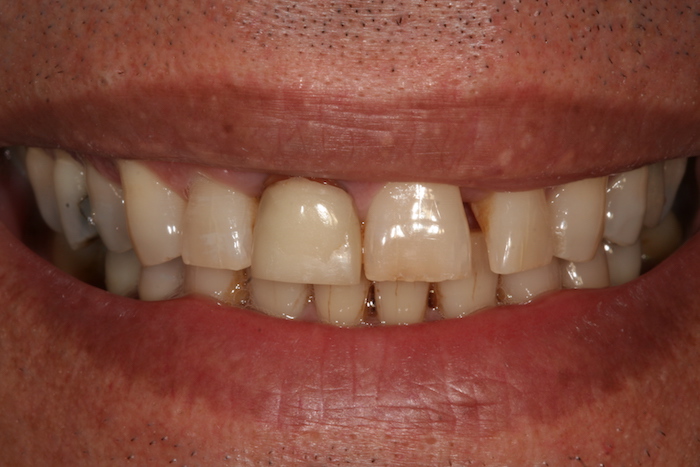 dentes-estetica|implantes:antes