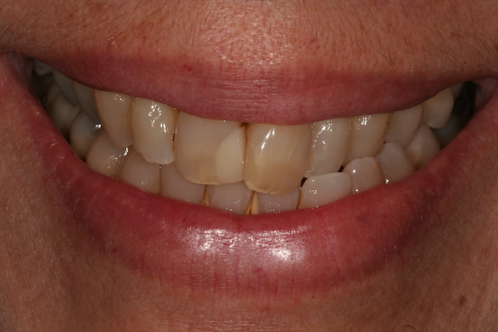 branqueamento-dentario|dentes-estetica:antes
