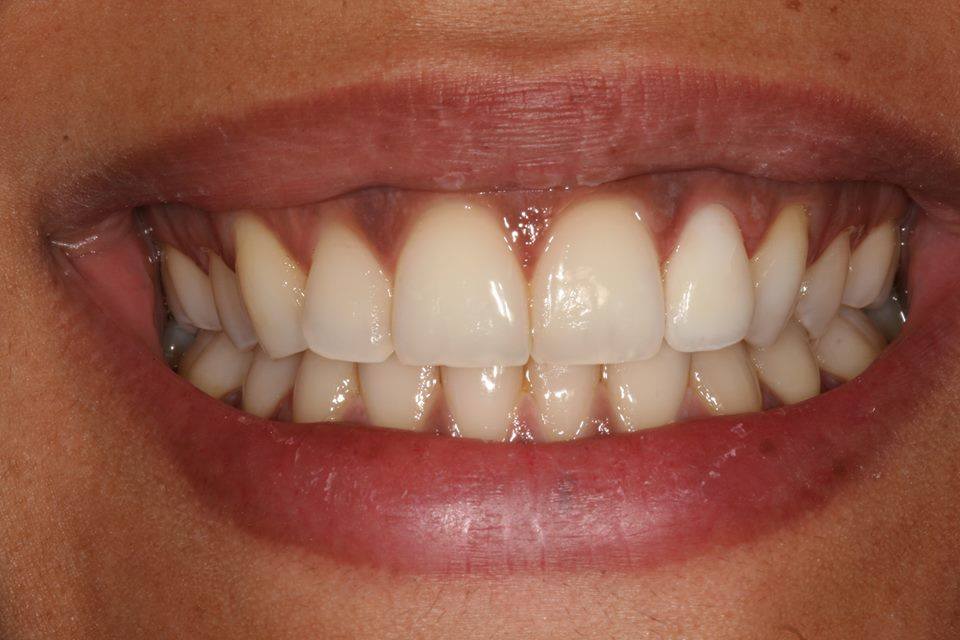 Small Intervention with Big Results: Veneers