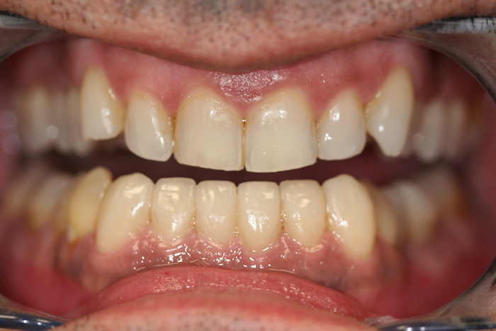 Lower Incisors Crowding Management without Braces