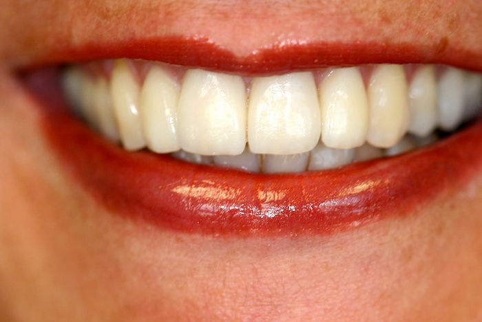 Tooth Alignment with Veneers