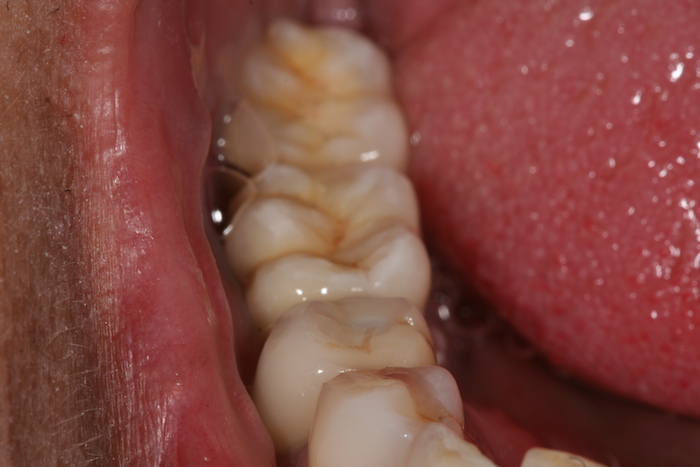 Oral Rehabilitation Over Implants