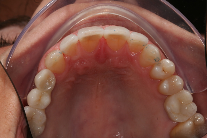 Reabilitação do maxilar superior: coroa, pontes e facetas