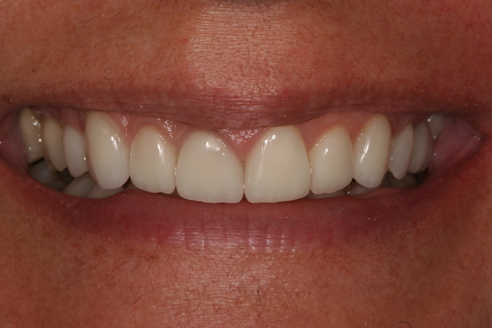 Lifting do Sorriso / Correção Desalinhamento Dentário com Facetas de Cerâmica