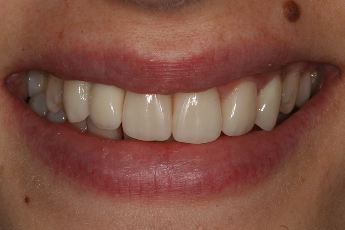 Lateral Incisors Agenesia: Implants and Veneers