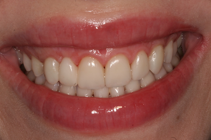Smile Makeover – Congenital Lack of Agenesis (Upper Lateral Right Incisor)