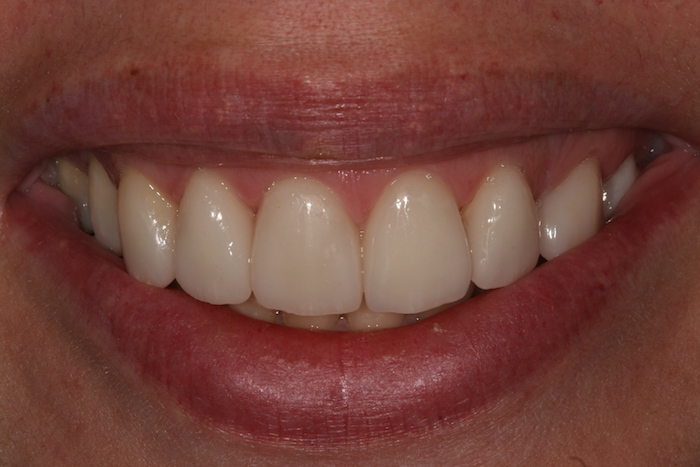 Gum Recontouring and Smille Harmonization with Porcelain Veneers