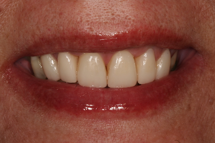 branqueamento-dentario|dentes-estetica