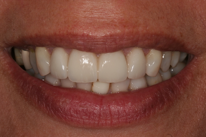 Smille Lift and Gum Recontouring