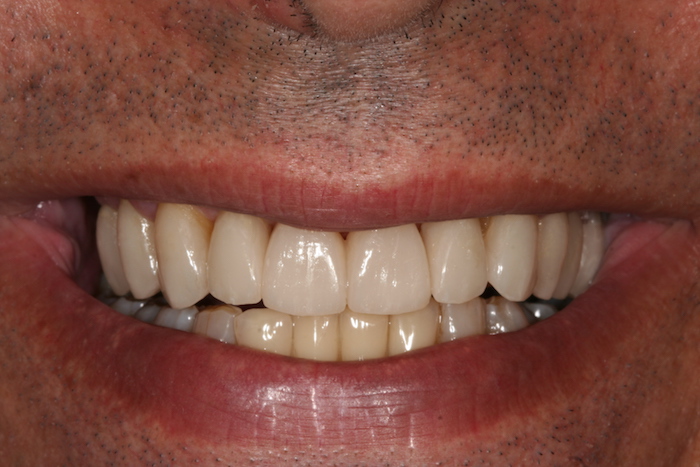 Smile Lift (2 Appointments/1 Month)