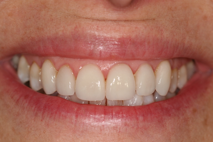 branqueamento-dentario|dentes-estetica