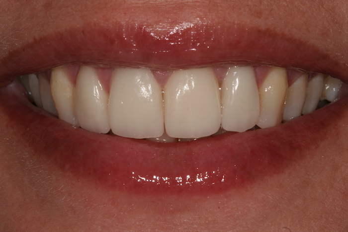 Tooth Alignment with Ceramic Veneers