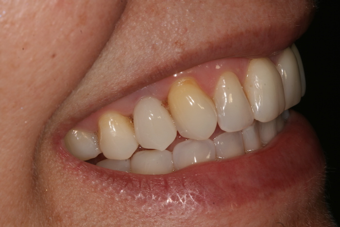 Implante no 1o pre-molar superior direito