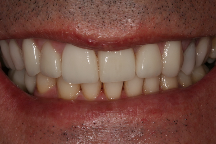 branqueamento-dentario|dentes-estetica|implantes|reabilitacao-oral