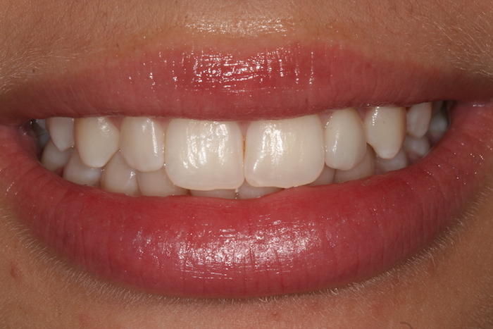 Small Interventions: Lateral Incisor Build Up