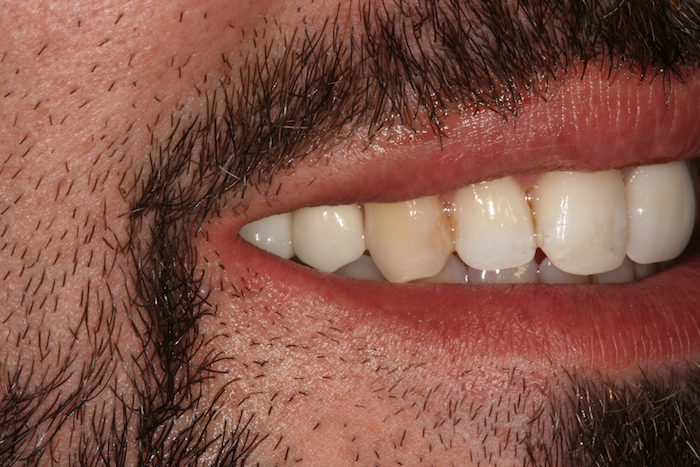 Implants on the premolar area