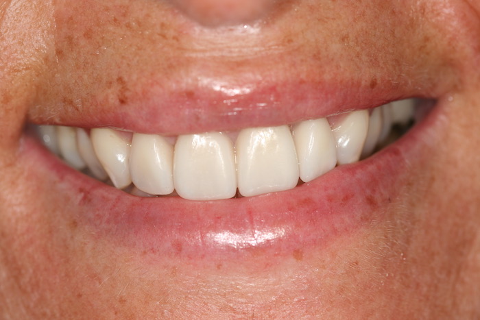 Dental Alignment and Smile Rejuvenation with Ceramic Veneers