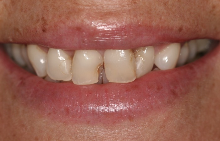 dentes-estetica:antes