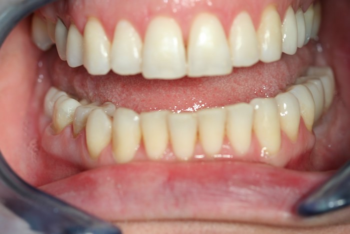 ortodontia:depois