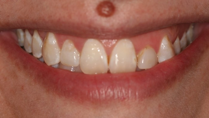 dentes-estetica:antes