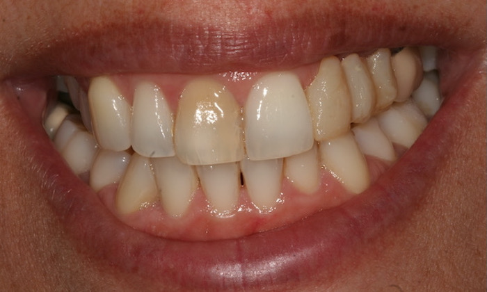 reabilitacao-oral|dentes-estetica:antes