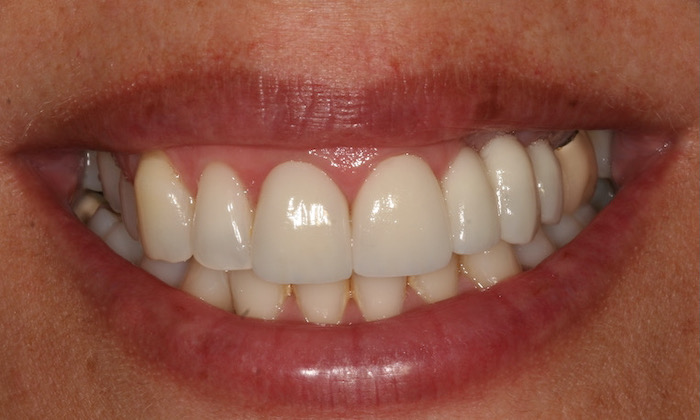 Reabilitação Oral - Lift do Sorriso