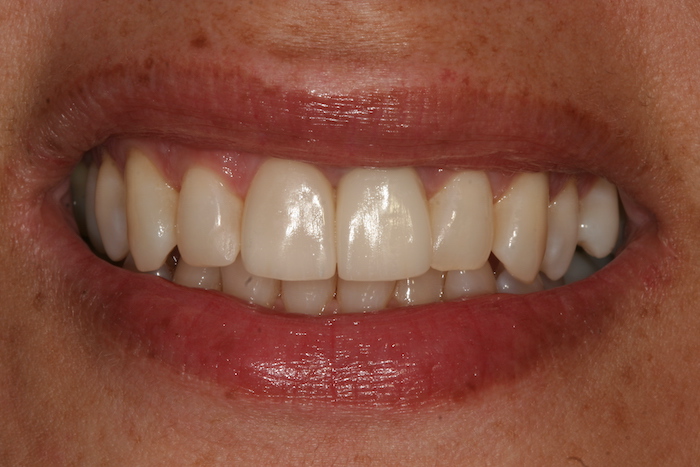 dentes-estetica|branqueamento-dentario:depois